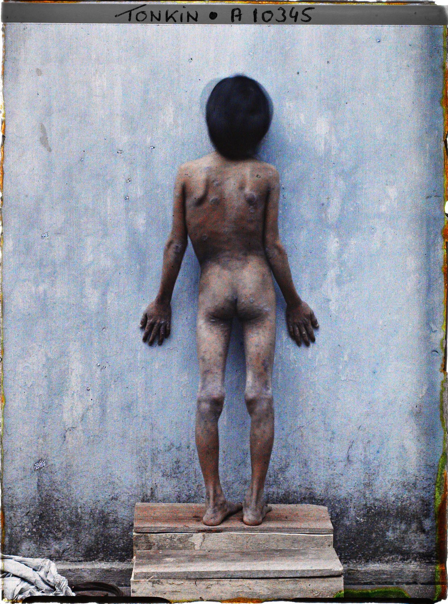 Image représentant Un enfant atteint de pian, photographié de dos à hôpital d'Hà-nôï