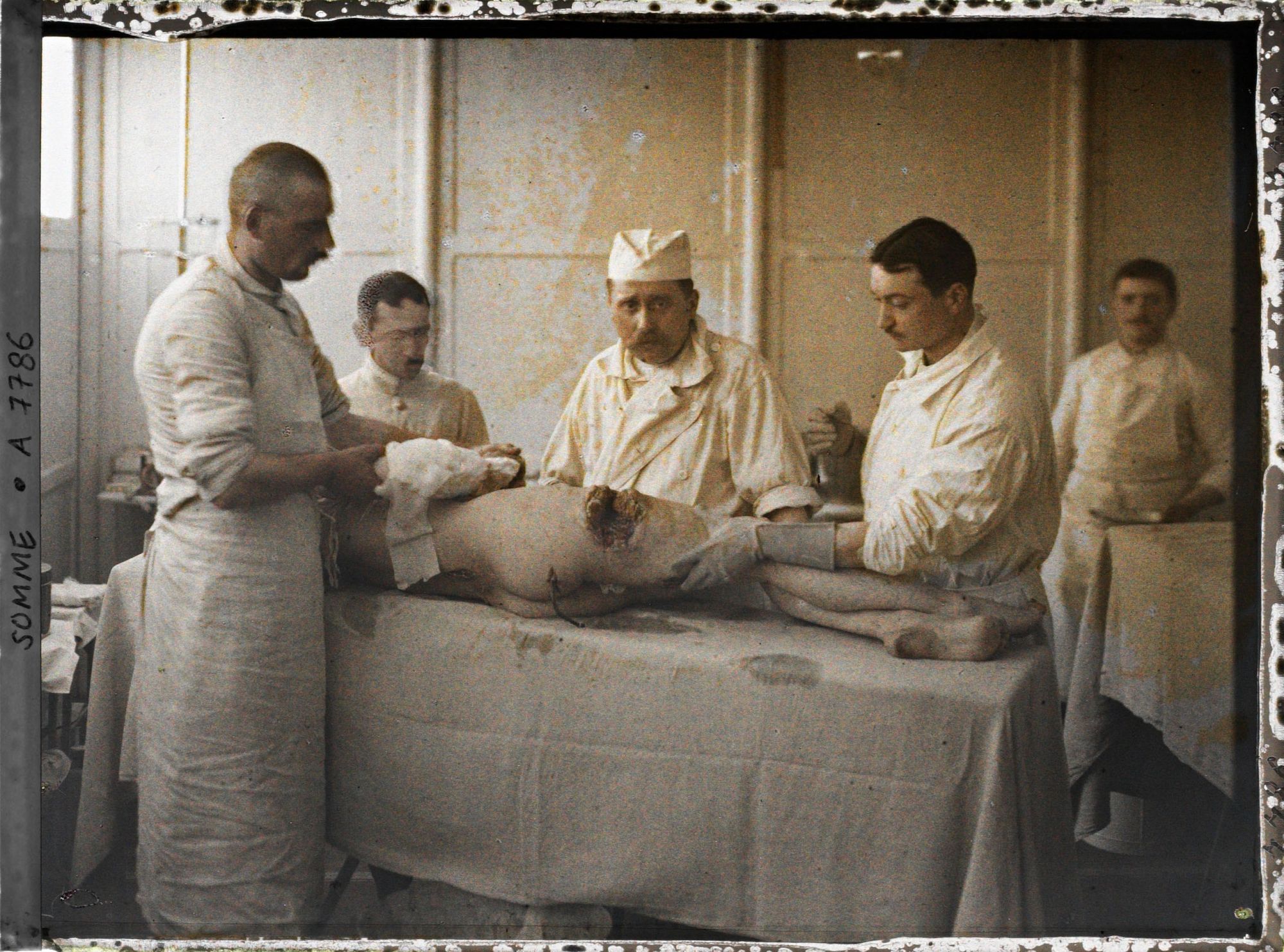 Image représentant Hôpital d'évacuation de Moreuil. Blessures produites par des éclats d'obus,