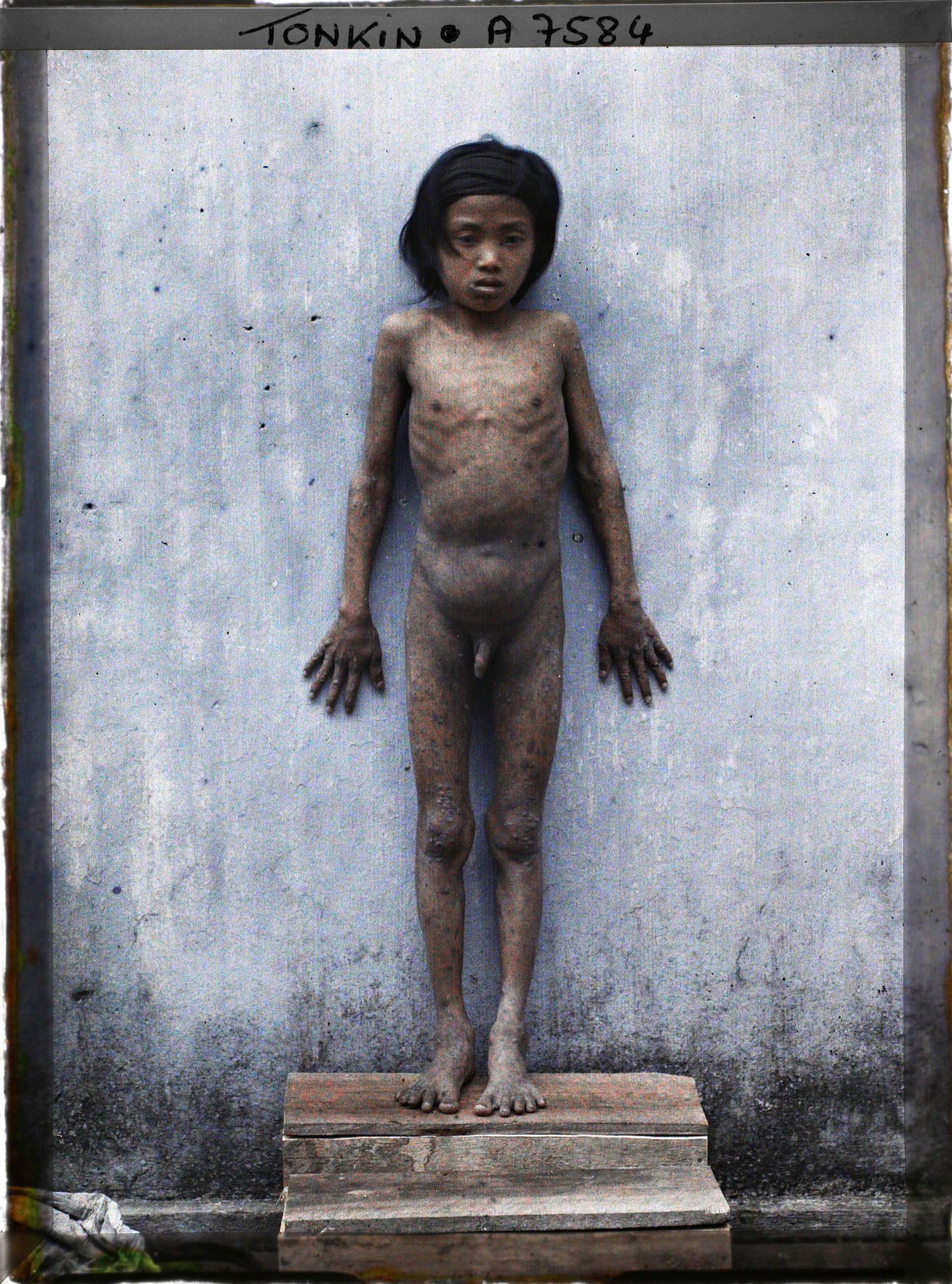 Image représentant Un enfant atteint de pian, photographié de face à l'hôpital d'Hà-nôï