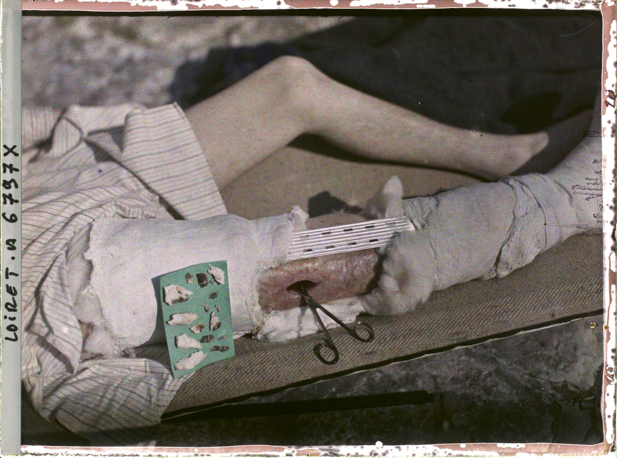 Image représentant France, Beaugency, Hopital militaire 47. Boussagol de Camarès (Aveyron) avec plaque verte d'esquilles