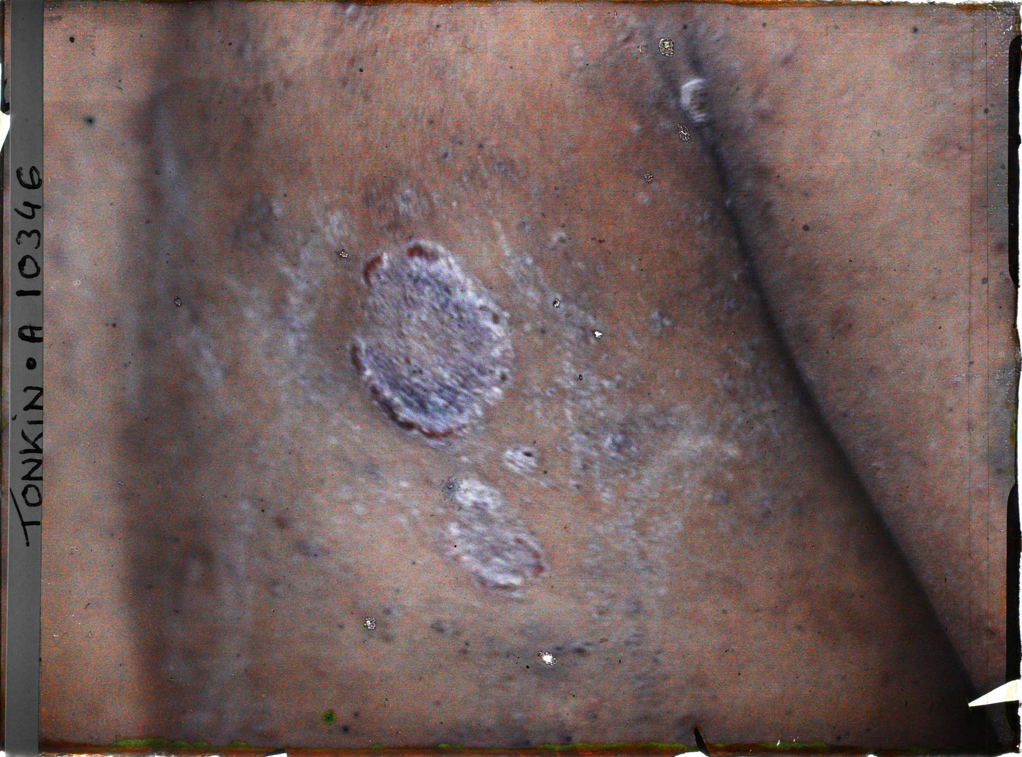 Image représentant Vue d'une pustule d'un enfant atteint de pian