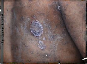 Image représentant Vue d'une pustule d'un enfant atteint de pian