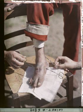 Image représentant France, Beaugency, Hopital militaire 47. Legay, pied guéri en 20 jours, 3 fistules suppurantes depuis 5 mois