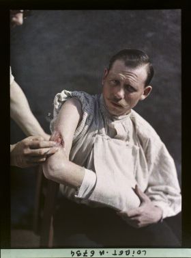 Image représentant Hôpital militaire 47, fistule de l'humérus avec bourgeon exhubérant datant de huit mois