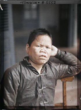 Image représentant Un lépreux dans une léproserie de Du'ô'ng-té