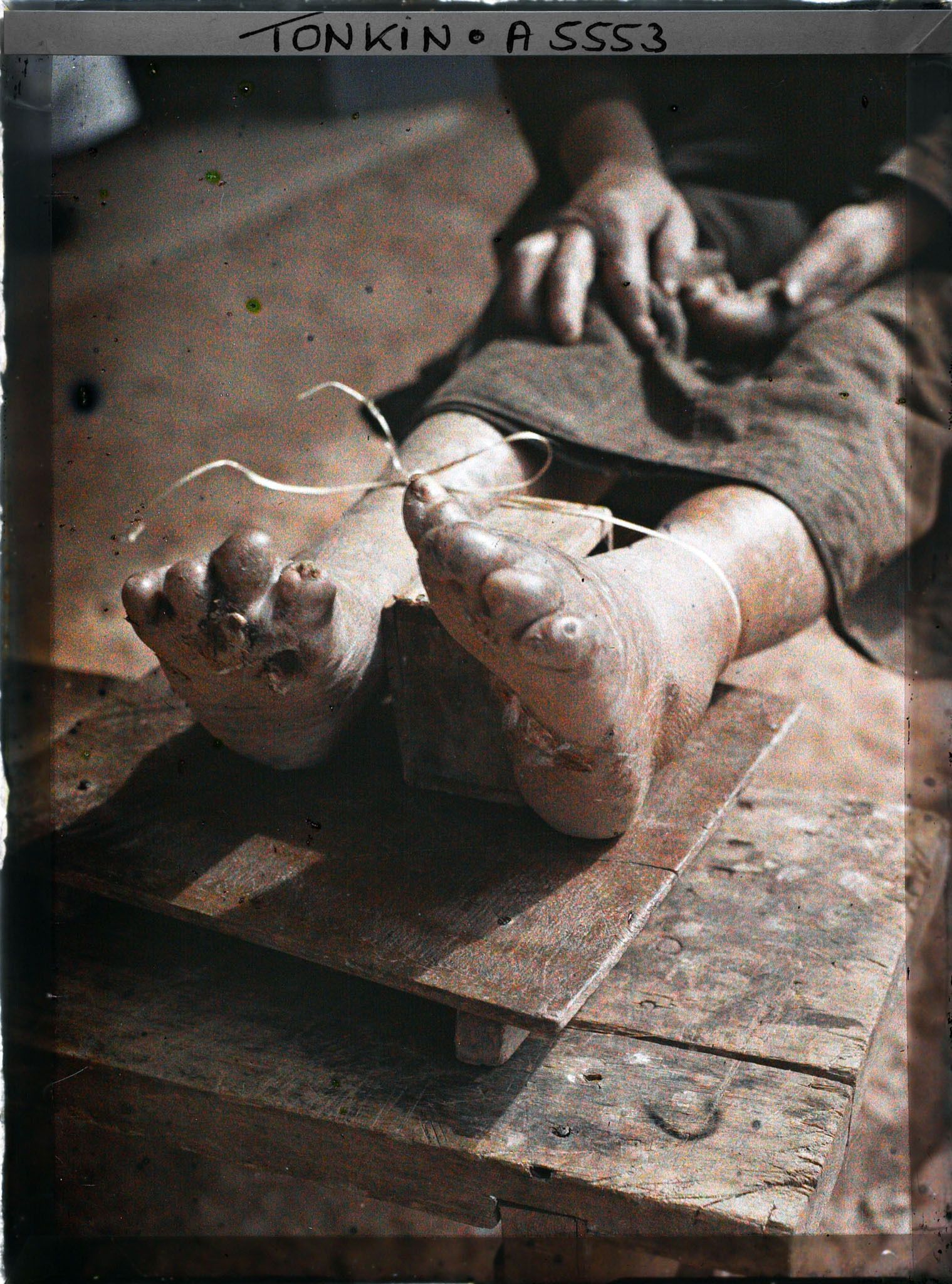 Image représentant Les pieds d'une lépreuse dans une léproserie de Du'ô'ng-té