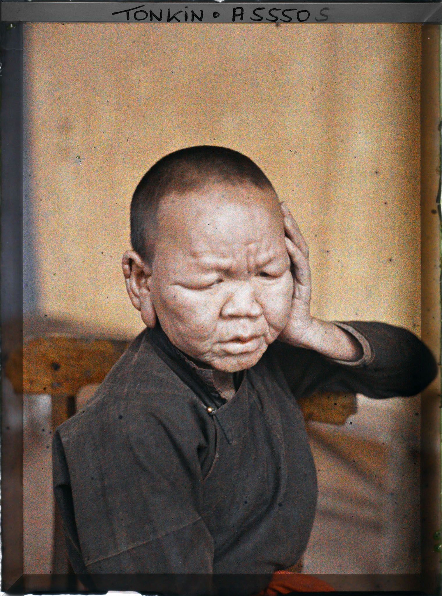 Image représentant Un lépreux dans une léproserie de Du'ôn'g-té